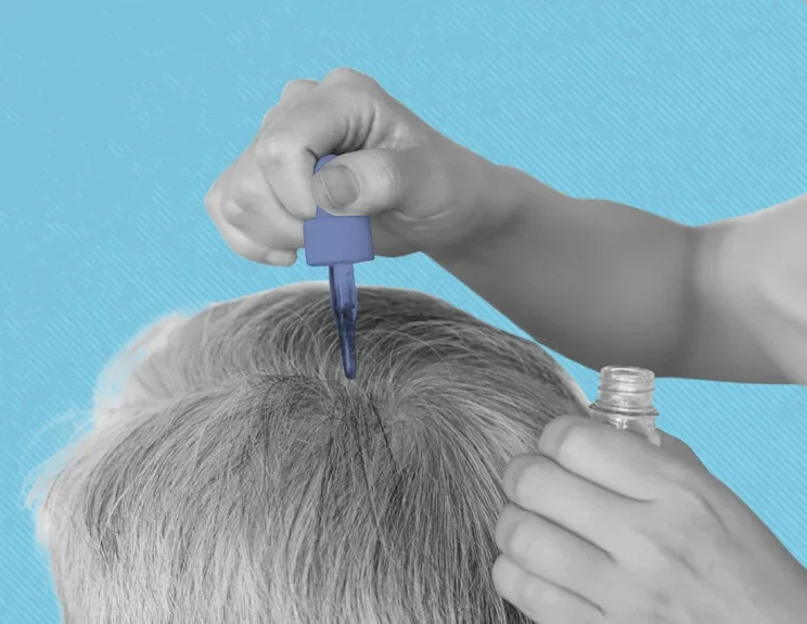 1407512-The-best-hair-loss-treatments-for-men-1296x728-Header-83d0ea-1024x575